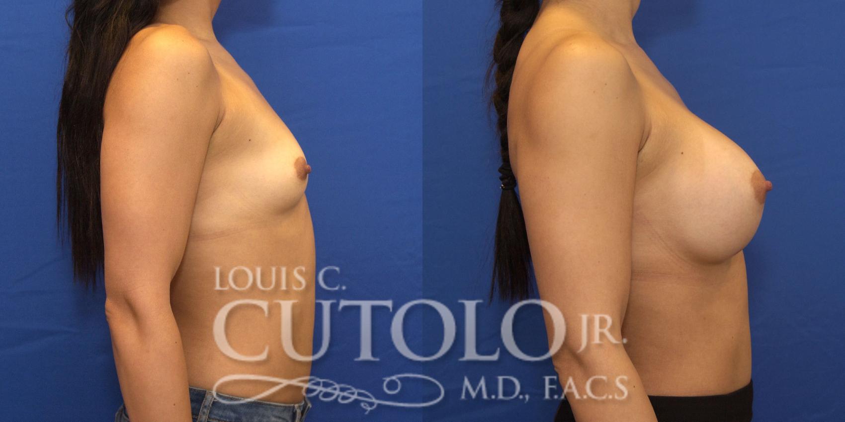 Before & After Breast Augmentation Case 199 View #6 View in Brooklyn, Staten Island, Queens, NY