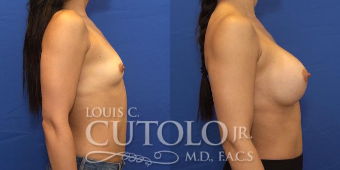 Before & After Breast Augmentation Case 199 View #6 View in Brooklyn, Staten Island, Queens, NY