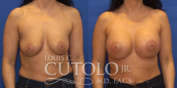 Before & After Breast Augmentation Case 201 View #1 View in Brooklyn, Staten Island, Queens, NY