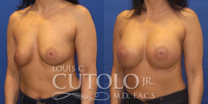 Before & After Breast Augmentation Case 201 View #2 View in Brooklyn, Staten Island, Queens, NY