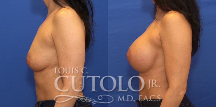 Before & After Breast Augmentation Case 201 View #3 View in Brooklyn, Staten Island, Queens, NY
