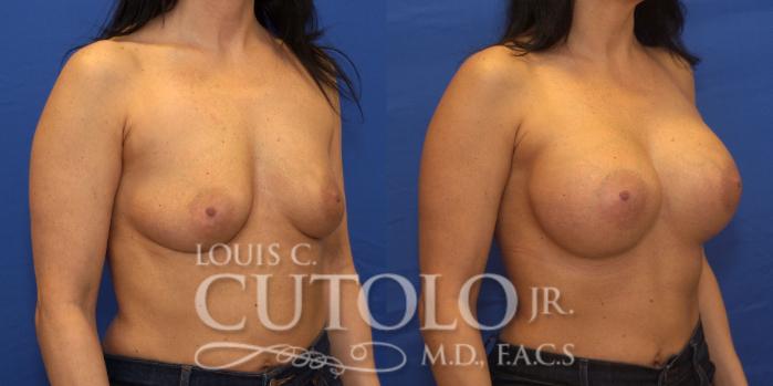 Before & After Breast Augmentation Case 201 View #4 View in Brooklyn, Staten Island, Queens, NY