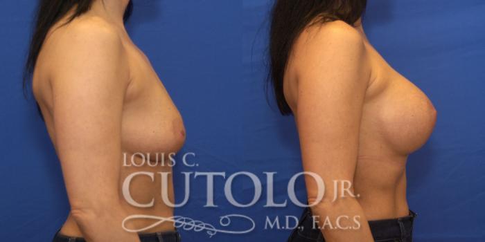 Before & After Breast Augmentation Case 201 View #5 View in Brooklyn, Staten Island, Queens, NY