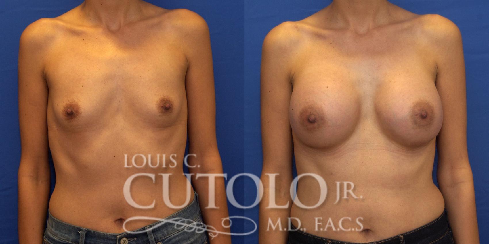 Before & After Breast Augmentation Case 202 View #1 View in Brooklyn, Staten Island, Queens, NY