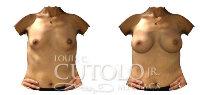 Before & After Breast Augmentation Case 202 View #2 View in Brooklyn, Staten Island, Queens, NY