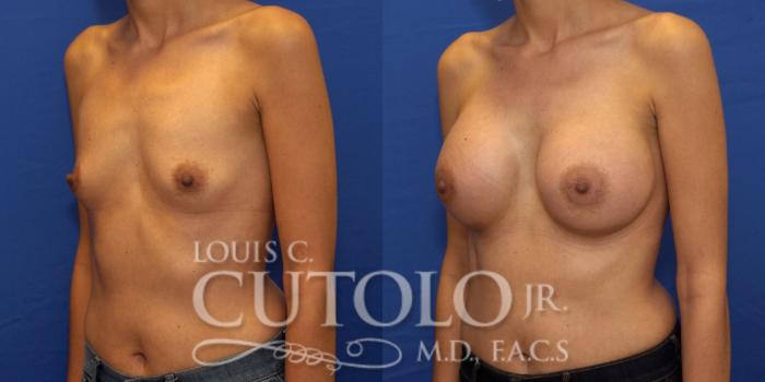 Before & After Breast Augmentation Case 202 View #3 View in Brooklyn, Staten Island, Queens, NY