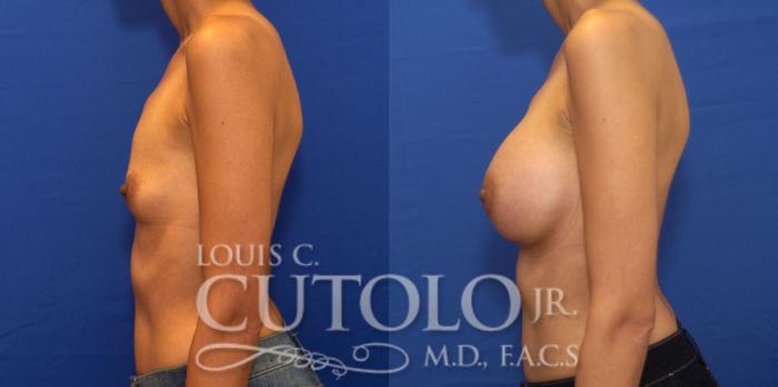 Before & After Breast Augmentation Case 202 View #4 View in Brooklyn, Staten Island, Queens, NY