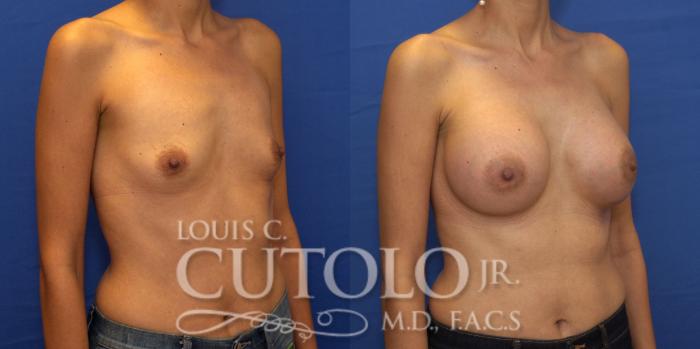 Before & After Breast Augmentation Case 202 View #5 View in Brooklyn, Staten Island, Queens, NY