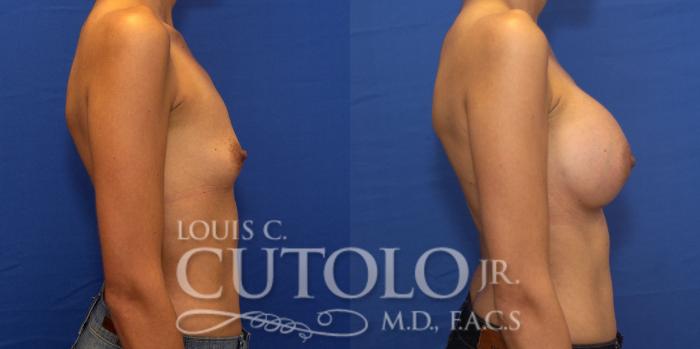 Before & After Breast Augmentation Case 202 View #6 View in Brooklyn, Staten Island, Queens, NY
