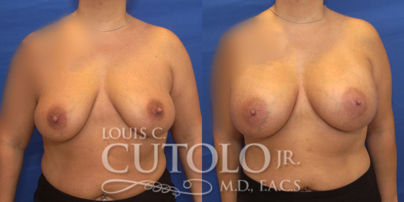 Before & After Breast Augmentation Case 204 View #1 View in Brooklyn, Staten Island, Queens, NY