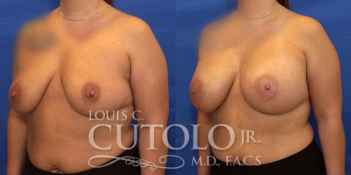 Before & After Breast Augmentation Case 204 View #2 View in Brooklyn, Staten Island, Queens, NY