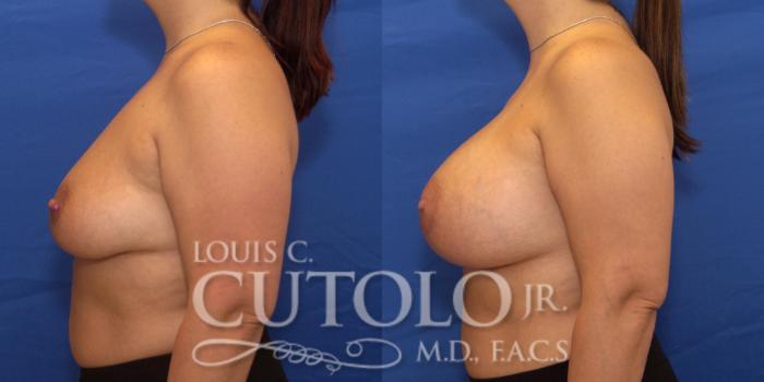 Before & After Breast Augmentation Case 204 View #3 View in Brooklyn, Staten Island, Queens, NY