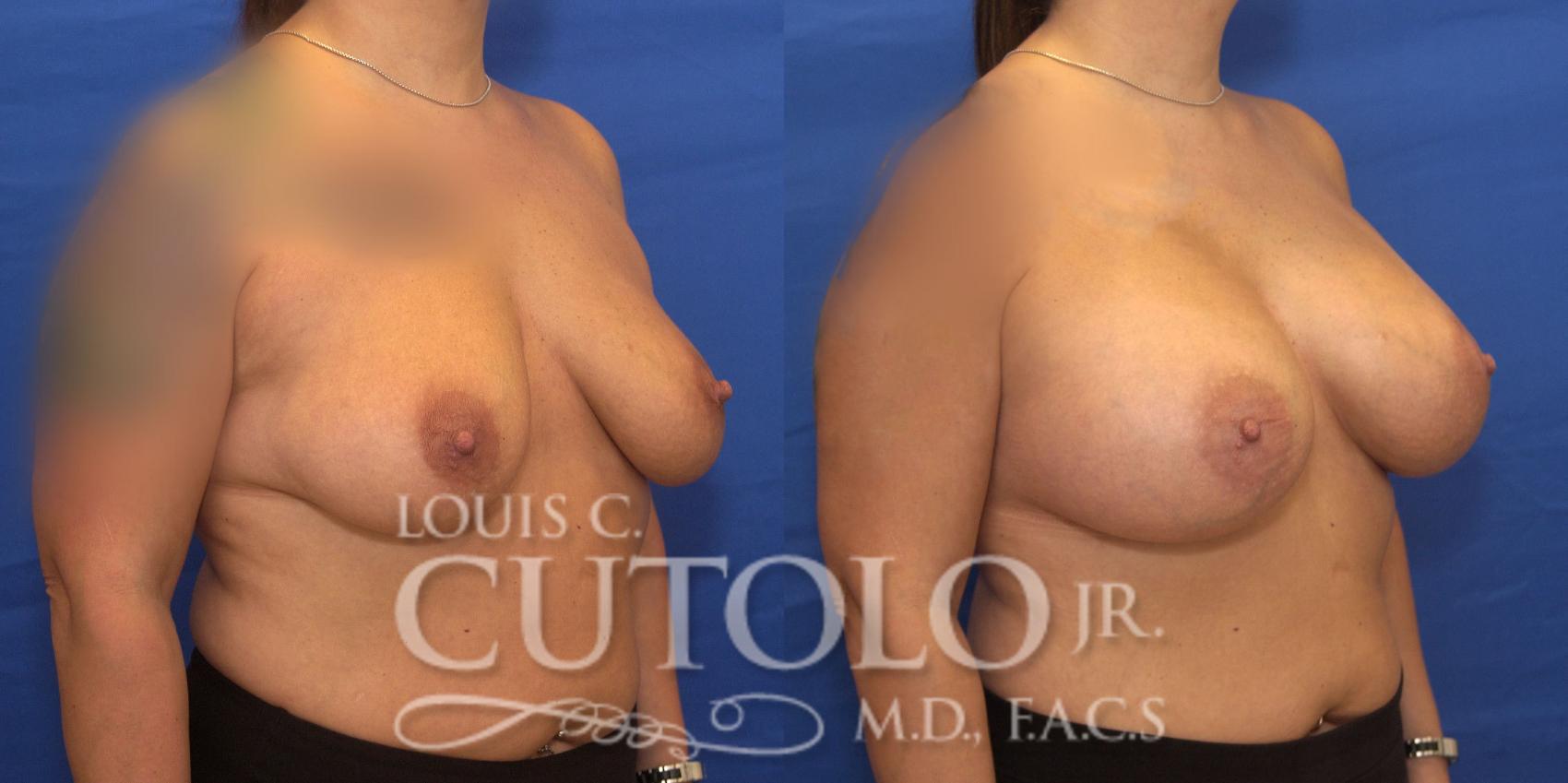 Before & After Breast Augmentation Case 204 View #4 View in Brooklyn, Staten Island, Queens, NY