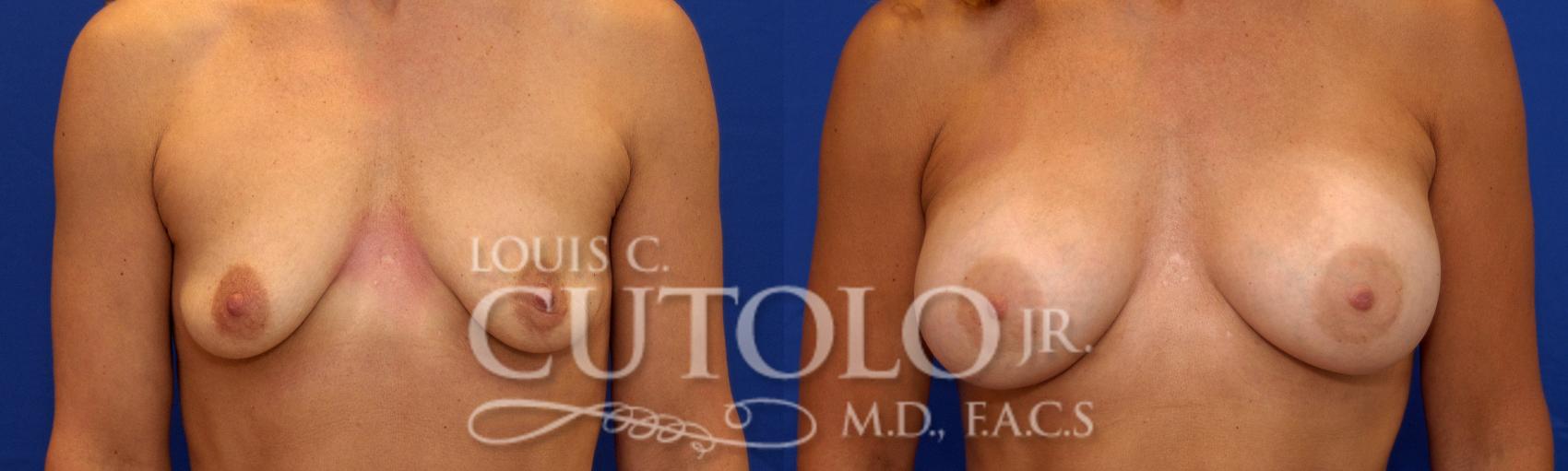 Before & After Breast Augmentation Case 21 View #1 View in Brooklyn, Staten Island, Queens, NY