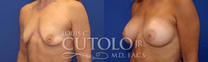 Before & After Breast Augmentation Case 21 View #2 View in Brooklyn, Staten Island, Queens, NY