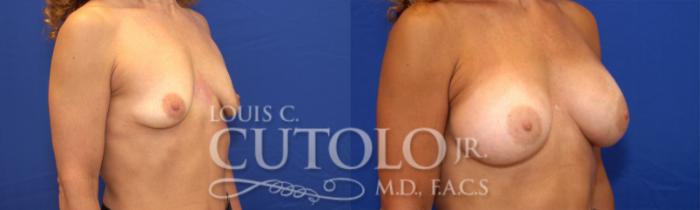 Before & After Breast Augmentation Case 21 View #3 View in Brooklyn, Staten Island, Queens, NY