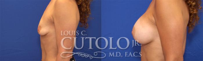 Before & After Breast Augmentation Case 21 View #4 View in Brooklyn, Staten Island, Queens, NY