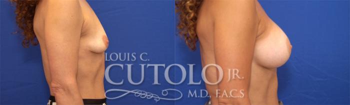 Before & After Breast Augmentation Case 21 View #5 View in Brooklyn, Staten Island, Queens, NY