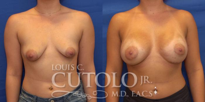 Before & After Breast Augmentation Case 211 View #1 View in Brooklyn, Staten Island, Queens, NY