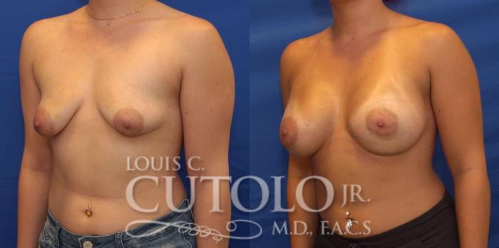 Before & After Breast Augmentation Case 211 View #2 View in Brooklyn, Staten Island, Queens, NY