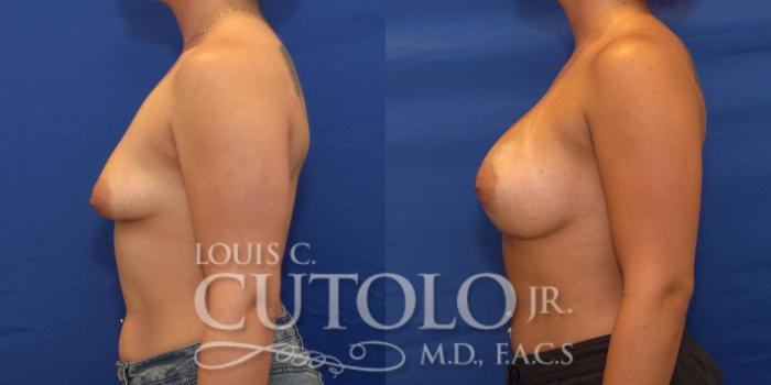 Before & After Breast Augmentation Case 211 View #3 View in Brooklyn, Staten Island, Queens, NY