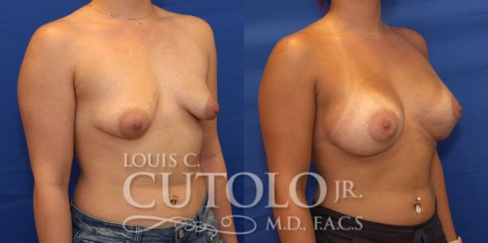 Before & After Breast Augmentation Case 211 View #4 View in Brooklyn, Staten Island, Queens, NY