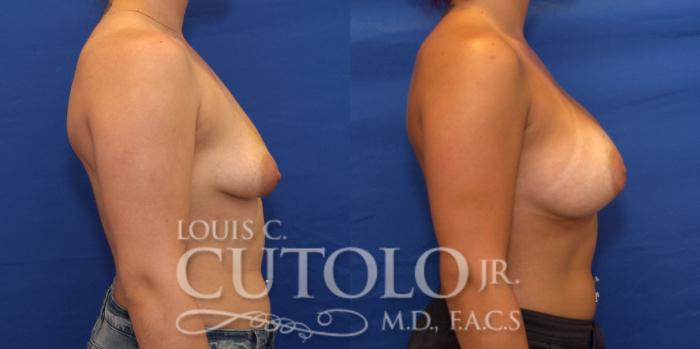 Before & After Breast Augmentation Case 211 View #5 View in Brooklyn, Staten Island, Queens, NY