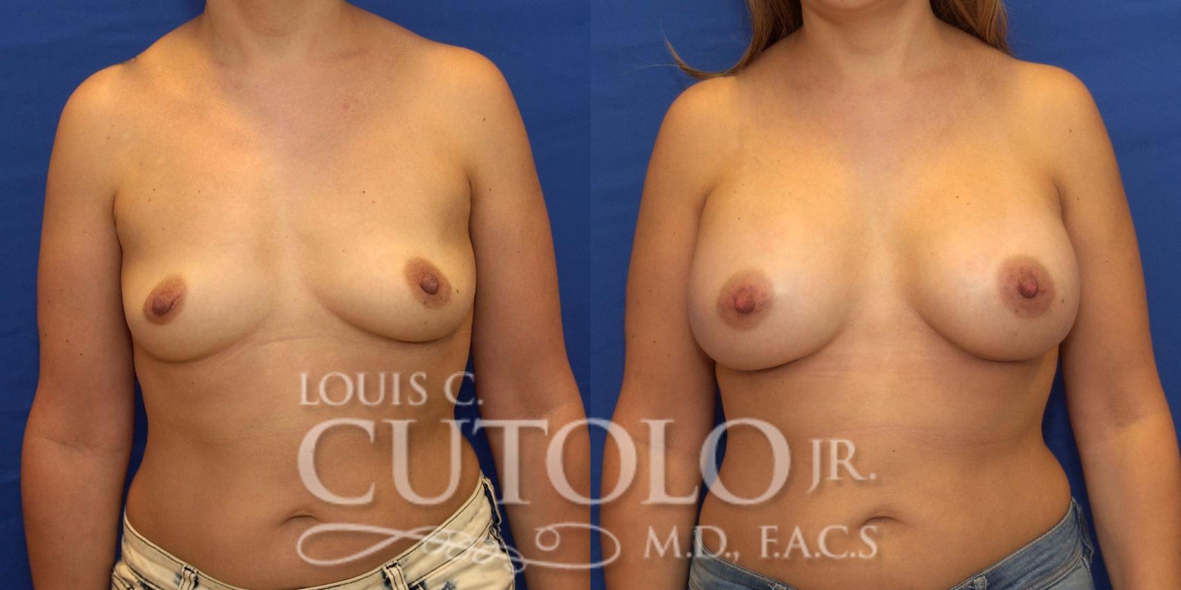 Before & After Breast Augmentation Case 214 View #1 View in Brooklyn, Staten Island, Queens, NY