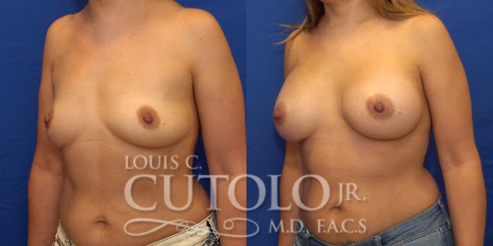 Before & After Breast Augmentation Case 214 View #2 View in Brooklyn, Staten Island, Queens, NY