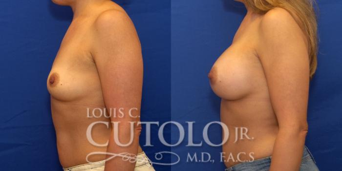 Before & After Breast Augmentation Case 214 View #3 View in Brooklyn, Staten Island, Queens, NY