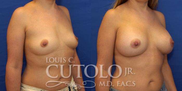 Before & After Breast Augmentation Case 214 View #4 View in Brooklyn, Staten Island, Queens, NY