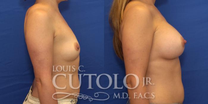 Before & After Breast Augmentation Case 214 View #5 View in Brooklyn, Staten Island, Queens, NY