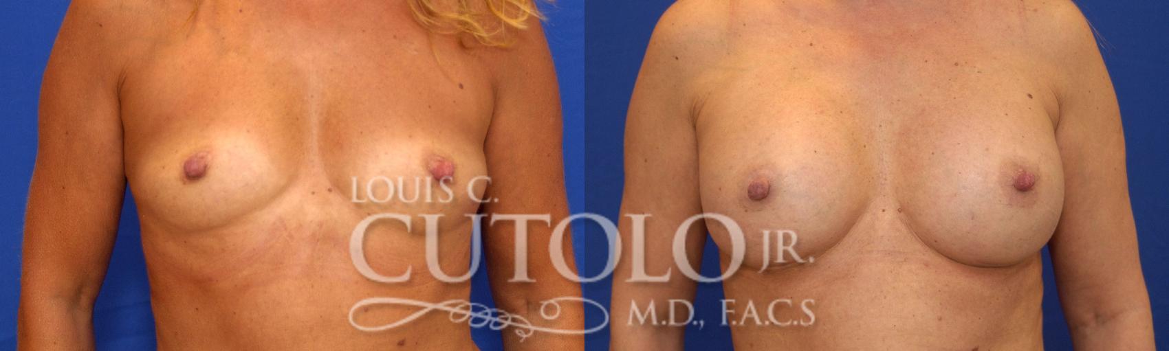 Before & After Breast Augmentation Case 22 View #1 View in Brooklyn, Staten Island, Queens, NY