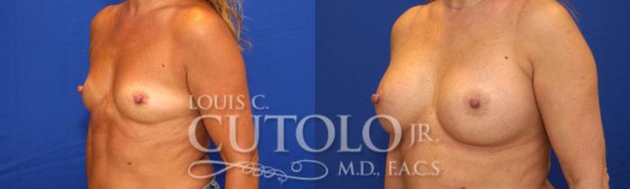 Before & After Breast Augmentation Case 22 View #2 View in Brooklyn, Staten Island, Queens, NY