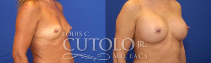 Before & After Breast Augmentation Case 22 View #3 View in Brooklyn, Staten Island, Queens, NY