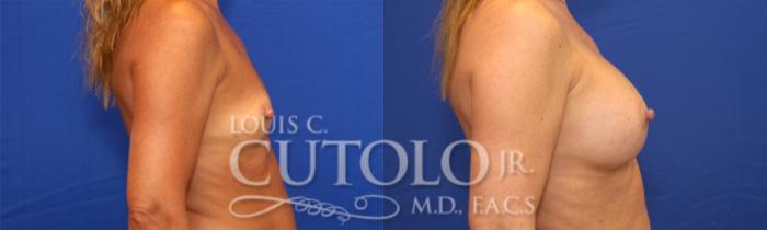 Before & After Breast Augmentation Case 22 View #5 View in Brooklyn, Staten Island, Queens, NY