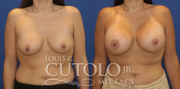 Before & After Breast Augmentation Case 220 View #1 View in Brooklyn, Staten Island, Queens, NY