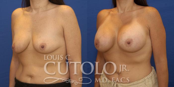 Before & After Breast Augmentation Case 220 View #2 View in Brooklyn, Staten Island, Queens, NY