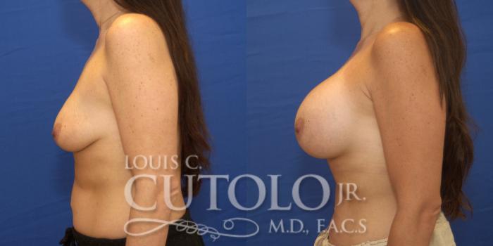 Before & After Breast Augmentation Case 220 View #3 View in Brooklyn, Staten Island, Queens, NY