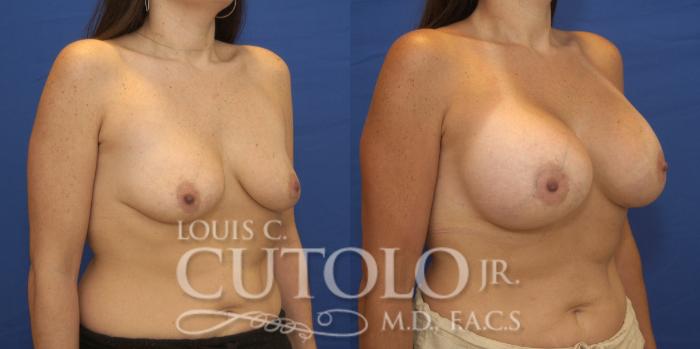 Before & After Breast Augmentation Case 220 View #4 View in Brooklyn, Staten Island, Queens, NY