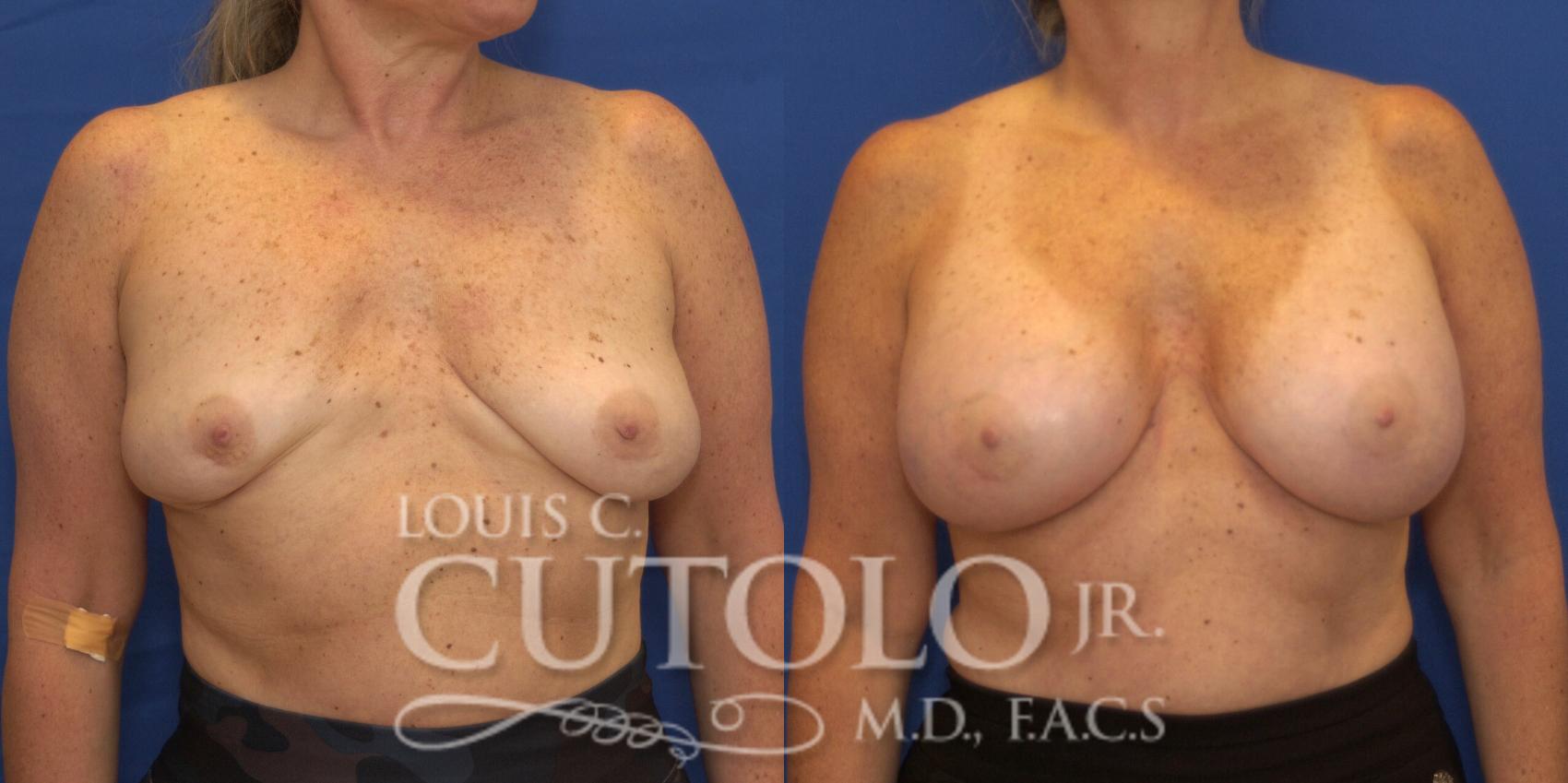 Before & After Breast Augmentation Case 222 View #1 View in Brooklyn, Staten Island, Queens, NY
