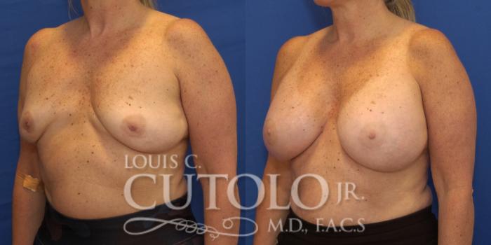 Before & After Breast Augmentation Case 222 View #2 View in Brooklyn, Staten Island, Queens, NY