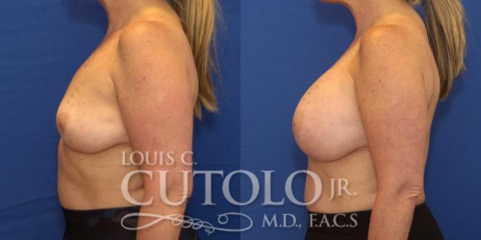 Before & After Breast Augmentation Case 222 View #3 View in Brooklyn, Staten Island, Queens, NY