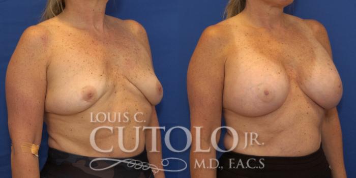 Before & After Breast Augmentation Case 222 View #4 View in Brooklyn, Staten Island, Queens, NY