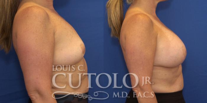 Before & After Breast Augmentation Case 222 View #5 View in Brooklyn, Staten Island, Queens, NY