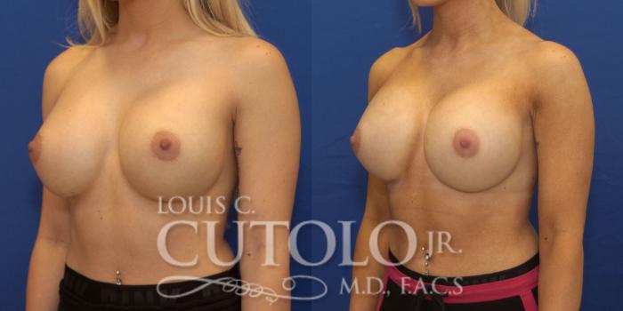 Before & After Breast Augmentation Case 227 View #2 View in Brooklyn, Staten Island, Queens, NY