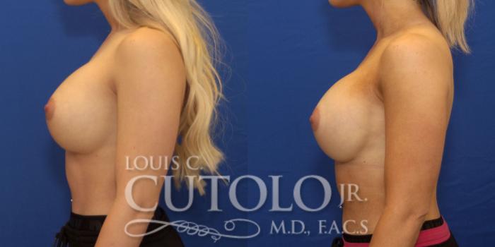 Before & After Breast Augmentation Case 227 View #3 View in Brooklyn, Staten Island, Queens, NY