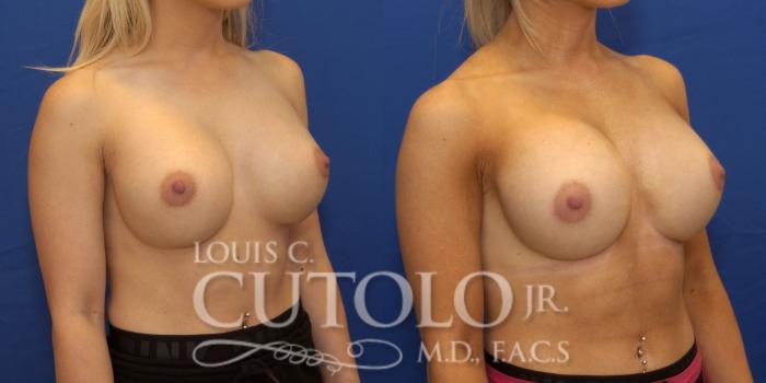 Before & After Breast Augmentation Case 227 View #4 View in Brooklyn, Staten Island, Queens, NY