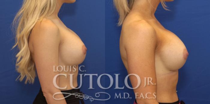 Before & After Breast Augmentation Case 227 View #5 View in Brooklyn, Staten Island, Queens, NY