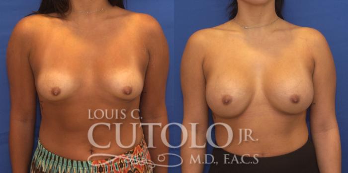 Before & After Breast Augmentation Case 228 View #1 View in Brooklyn, Staten Island, Queens, NY